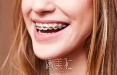 20岁做牙齿矫正会太晚吗？有用吗？ width=