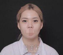 周柯隆鼻案例图片，来看下恢复得还算不错吧! width=