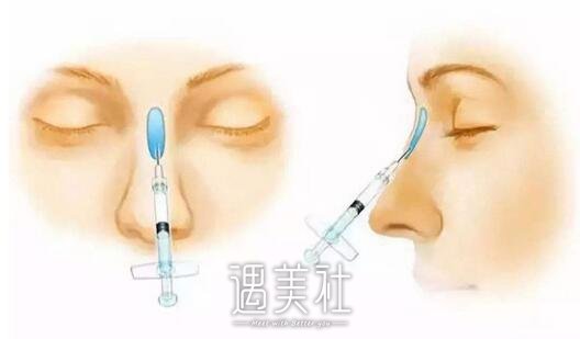 注射玻尿酸隆鼻多少钱