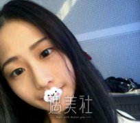 华西医院肖海涛双眼皮案例：老姐看了都想去做！ width=