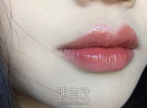 南阳,玻尿酸丰唇