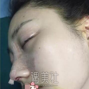 李青峰,做鼻子
