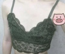 李朕丰胸案例：早就听说李朕医生很擅长隆胸喃～ width=
