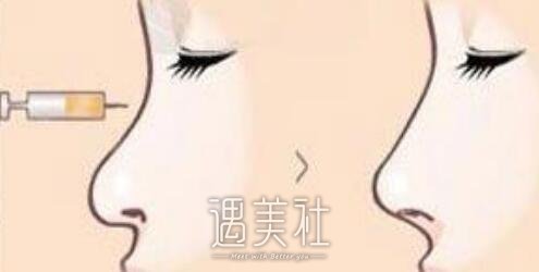 自体脂肪隆鼻