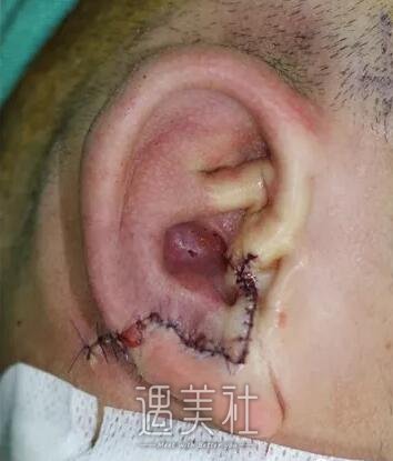 章庆国再造耳图片分享：恢复果很让人满意~