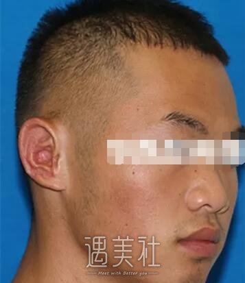 章庆国再造耳图片分享：恢复果很让人满意~