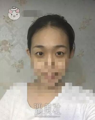 天津美莱整形医院实力怎么样?双眼皮真实案例分享~