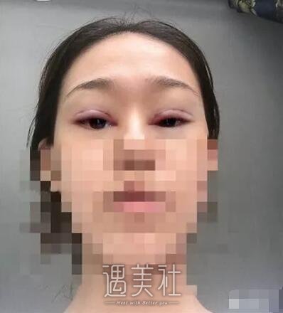 天津美莱整形医院实力怎么样?双眼皮真实案例分享~