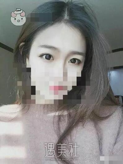 天津美莱整形医院实力怎么样?双眼皮真实案例分享~
