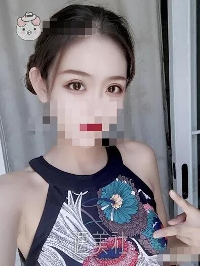 天津美莱整形医院实力怎么样?双眼皮真实案例分享~