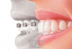 牙齿矫正如何选择好的医生？主要看哪几点呢？ width=