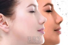 大连激光美白嫩肤有哪些优点，具体情况具体分析！ width=