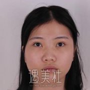 谢洋春鼻子做得怎么样？谢洋春隆鼻案例力证～ width=