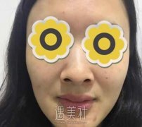 成都华美宋晓东隆鼻案例：术后经常被认成杨幂 width=