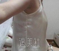 沈正宇隆胸案例：打造深V魔力美胸…… width=