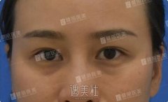广州健丽去眼袋案例：兜兜转转一年后选择了健丽~ width=