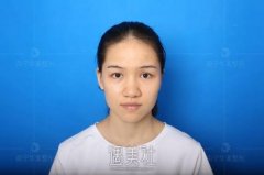 南宁华美卢志刚达拉斯隆鼻案例：土妹翻身成气质女神~ width=