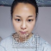 西安潘多拉整形医院靠谱吗?双眼皮案例及果图展示~ width=