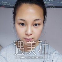 西安潘多拉整形医院靠谱吗?双眼皮案例及果图展示~