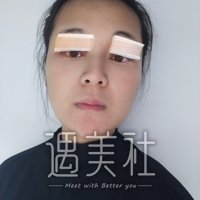 西安潘多拉整形医院靠谱吗?双眼皮案例及果图展示~