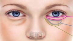 重庆眼部整形价钱如何定夺？受哪些因素影响喃？ width=