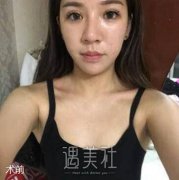 八大处唐勇隆胸案例：三个月万丈高楼平地起 width=
