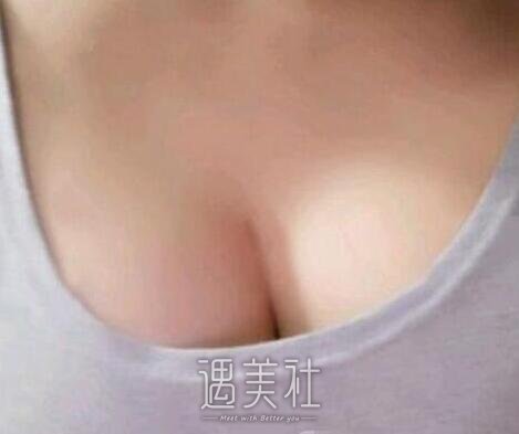 张立彬,丰胸