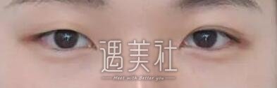 孙强,双眼皮