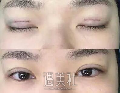 孙强,双眼皮