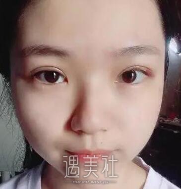 孙强,双眼皮