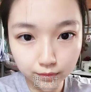 孙强,双眼皮