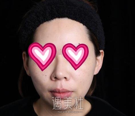 北京,八大处,杨欣,隆鼻