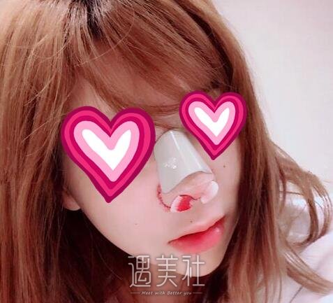 北京,八大处,杨欣,隆鼻