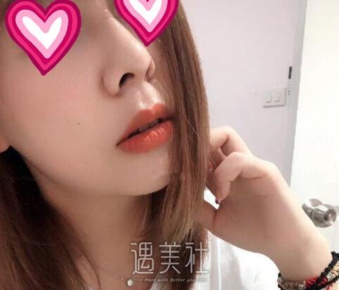 北京,八大处,杨欣,隆鼻