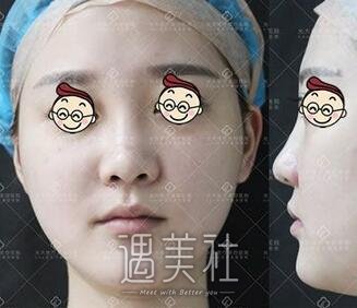 孙燚,隆鼻