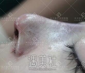 孙燚,隆鼻