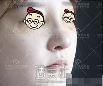 孙燚,隆鼻