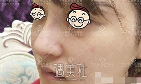 孙燚,隆鼻