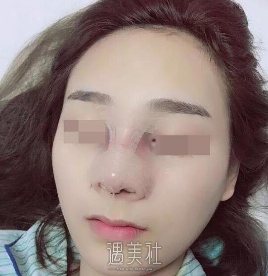 邢台人民医院整形科隆鼻技术如何?能人见人爱的果吗?