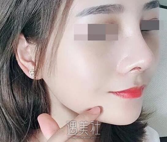 邢台人民医院整形科隆鼻技术如何?能人见人爱的果吗?