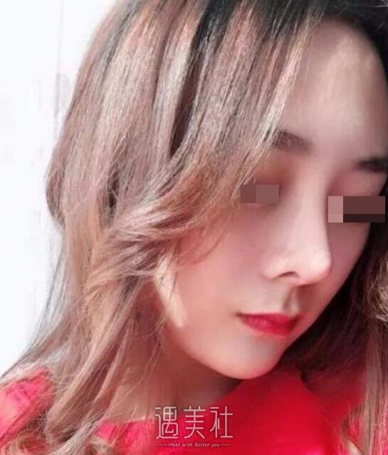 邢台人民医院整形科隆鼻技术如何?能人见人爱的果吗?