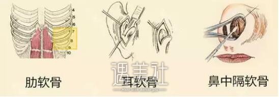 大同软骨隆鼻大概需要多少钱?什么样的价格合理?