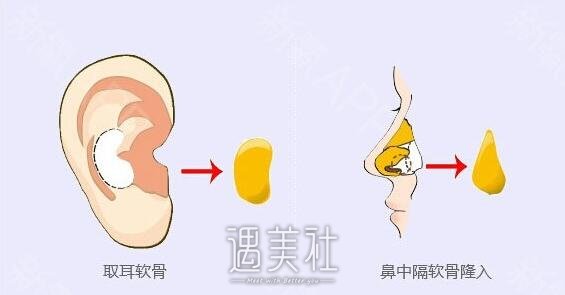南京做耳软骨隆鼻多少钱，每个人的价格都不同?