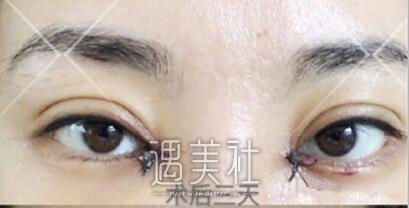 吴坤南,双眼皮修复