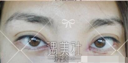 吴坤南,双眼皮修复