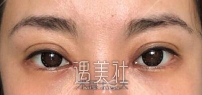 吴坤南,双眼皮修复