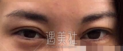 吴坤南,双眼皮修复