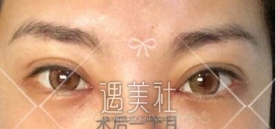 吴坤南,双眼皮修复