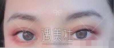吴坤南,双眼皮修复