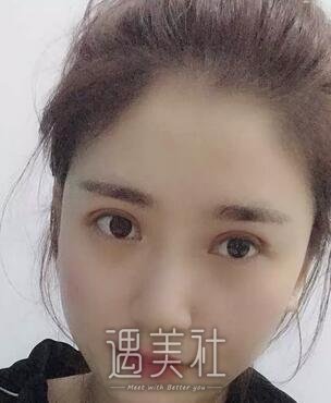 曹阳,双眼皮